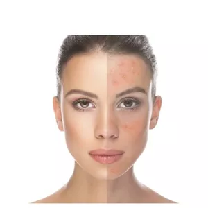 Manual da acne