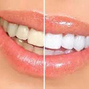 Imagem de capa para o Curso online Método CNM (Clareando os Dentes de  Forma Natural)
