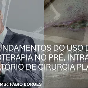 Curso Videoaula - Ozonioterapia no Pré, Intra e Pós-operatório de cirurgia plástica