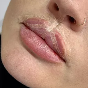 Strip Lips - Técnica de Preenchimento Labial 