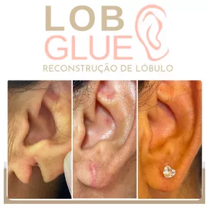 Imagem de capa para o Curso online Lob Glue- Técnica minimamente invasiva de reconstrução de lóbulo