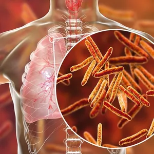 Imagem de capa para o Curso online Diagnóstico de Tuberculose