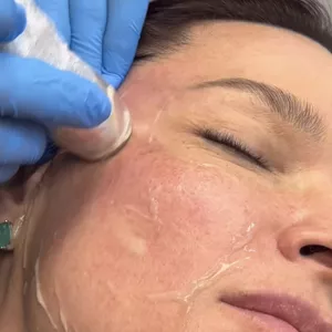 Imagem do curso WorkShop Visage - Ultrassom Microfocado