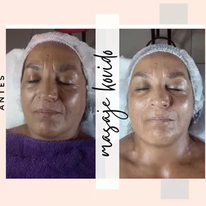 Imagen de portada para Curso online Lifting facial sin cirugía