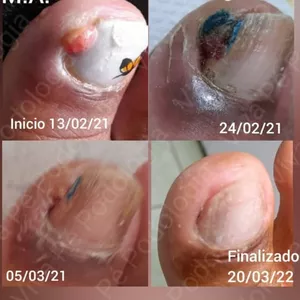 Imagem de capa para o Curso online Onicocriptose