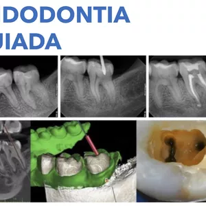 Imagem de capa para o Curso online Endodontia Guiada - Teoria