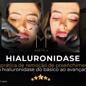 Imagem do curso Hialuronidase - Aula prática de remoção de preenchimento com hialuronidase do básico ao avançado.