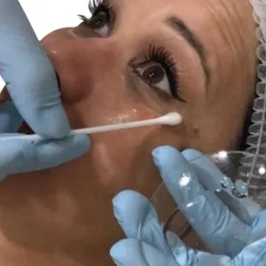 Imagem de capa para o Curso online MASTERCLASS EM PEELINGS QUÍMICOS 