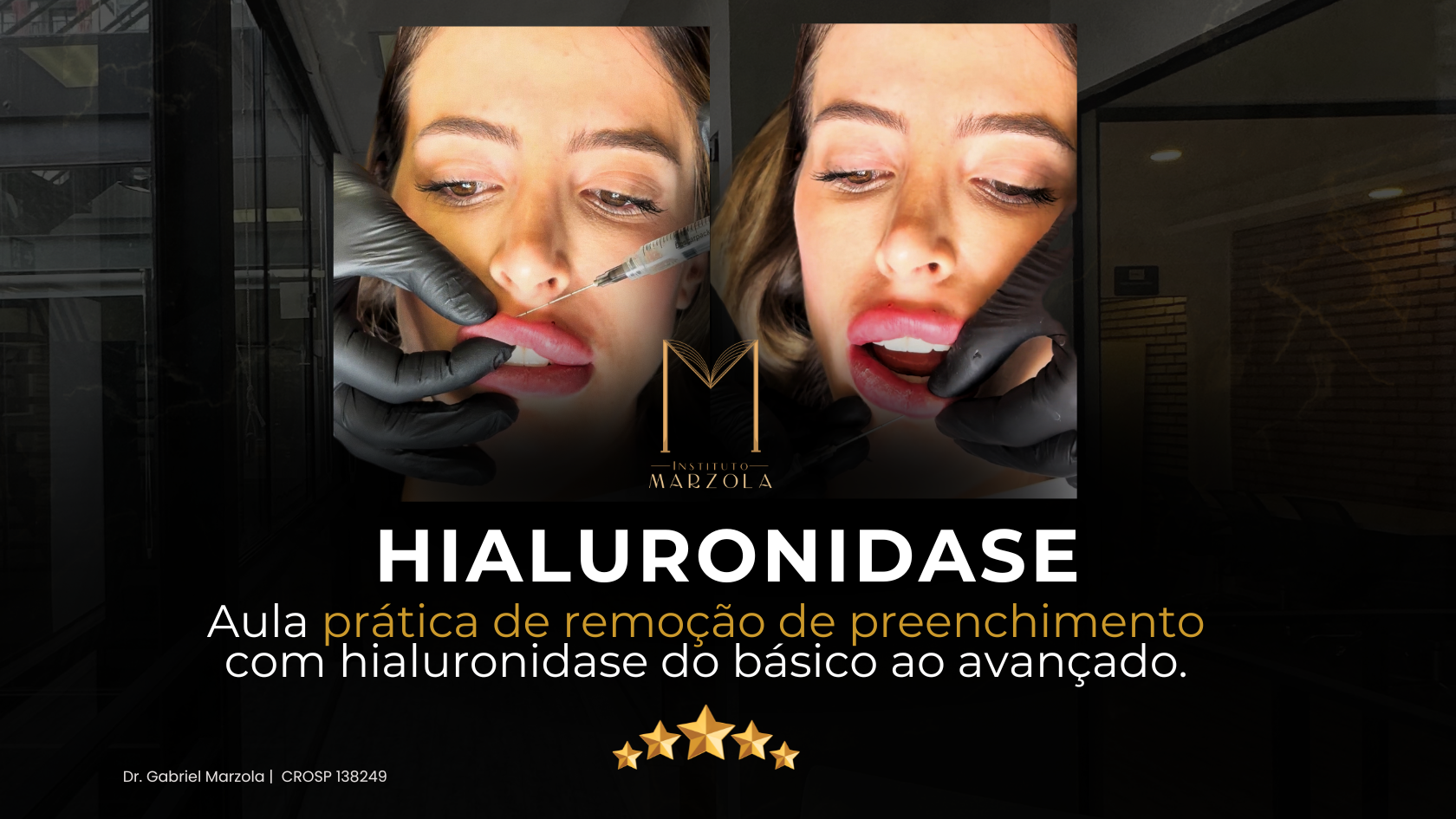 Imagem do curso Hialuronidase - Aula prática de remoção de preenchimento com hialuronidase do básico ao avançado.