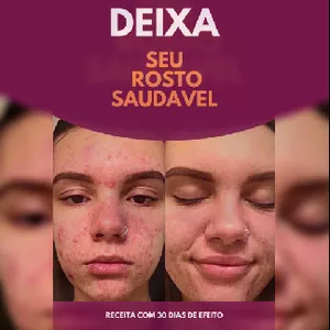 Imagem de capa para o Ebook Receita de remoção de espinhas 
