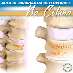 Imagem principal do produto AULA DE CIRURGIA DA OSTEOPOROSE NA COLUNA