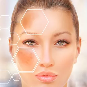 Imagen de portada para Curso online PIEL SIN MANCHAS