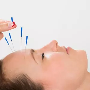 Imagem do curso Acupuntura&nbsp;Estética Facial