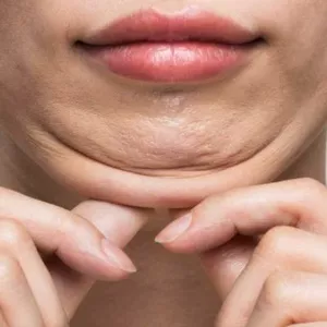 Imagen de portada para Curso online Lipólisis de papada