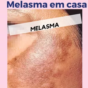Imagem de capa para o Ebook Como tratar seu Melasma em Casa