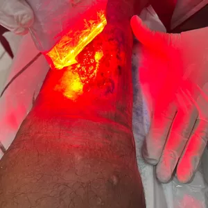 Imagem de capa para o Evento presencial Laserterapia - LASER E LED