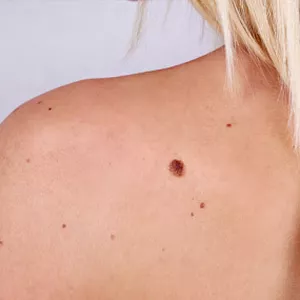 Imagem do curso Remoção de Verrugas com Jato de Plasma