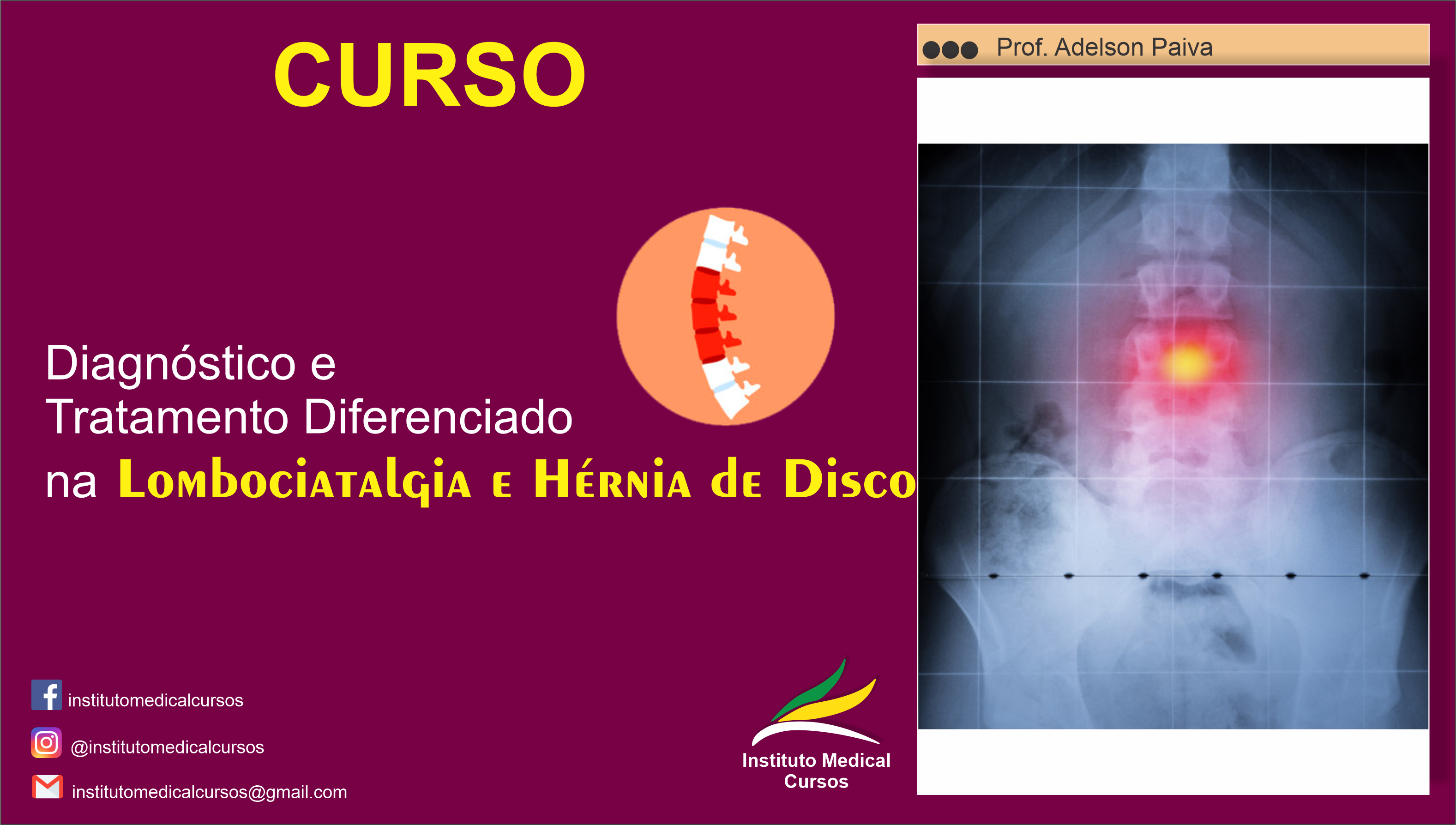Imagem do curso Diagnóstico e Tratamento Diferenciado na Lombociatalgia e Hérnia de Disco 