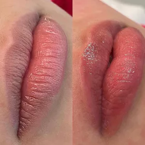 Imagen de portada para Curso online CURSO BBLIPS (MICRONEEDLING)