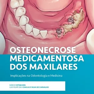 Imagem de capa para o Curso online Osteonecrose Medicamentosa dos Maxilares - Pré lançamento&nbsp;(16/10/25)