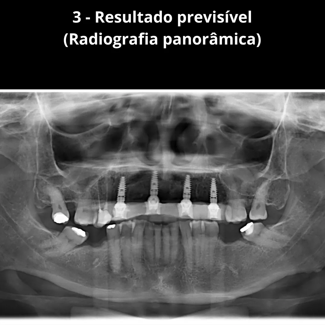 Livre-se do Stress na Implantodontia: Cirurgias Seguras e Confiantes com o Método Áquila de Igor Rizo CUPOM DE DESCONTO