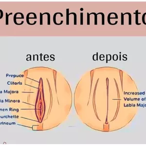 Preenchimento Intimo Feminino
