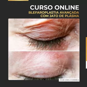 Imagem principal do produto Curso de Blefaroplastia Avançado com Jato de Plasma